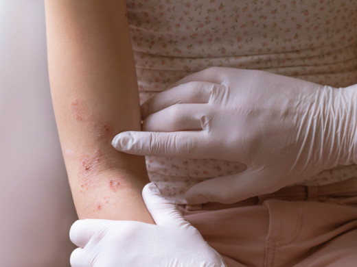 Ekzematik v ordinaci praktického lékaře