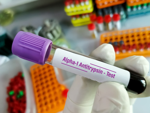 V Česku by mohla vzniknout další centra, kde léčí genetickou vadu